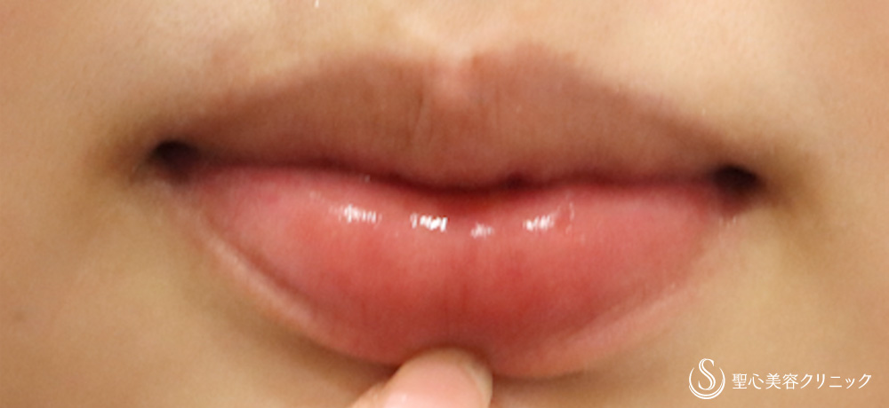 しみ・アザ取りレーザー_After