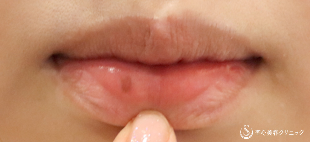 しみ・アザ取りレーザー_Before