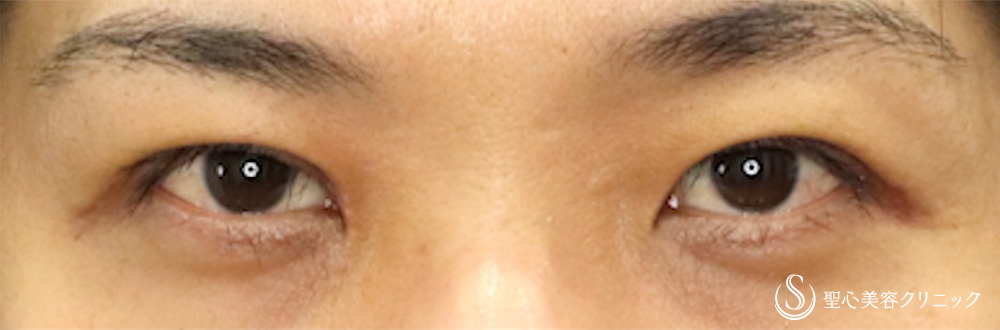 二重術（切開法）部分切開/全切開＋ 目上切開_After