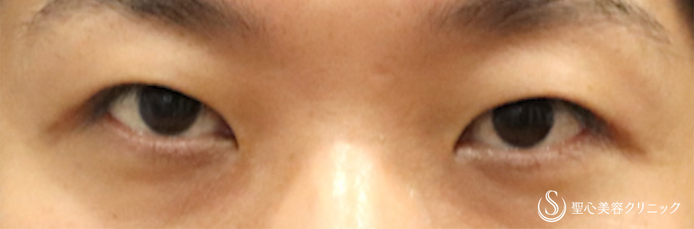 二重術（切開法）部分切開/全切開＋ 目上切開_Before