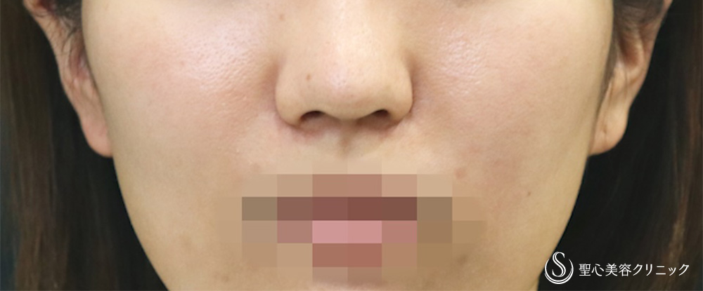 小鼻縮小_After