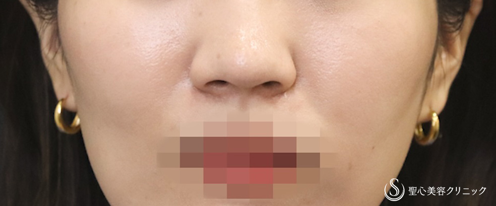 小鼻縮小_Before