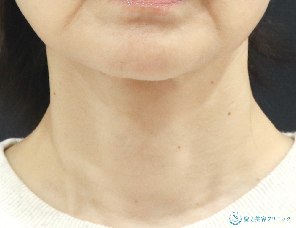 プレミアムPRP皮膚再生療法_After