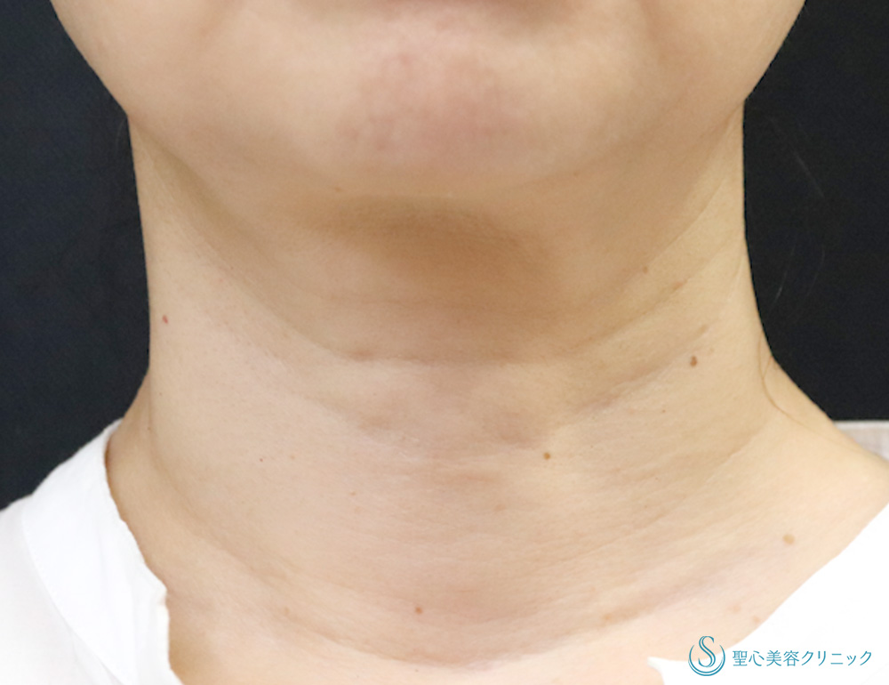 プレミアムPRP皮膚再生療法_Before
